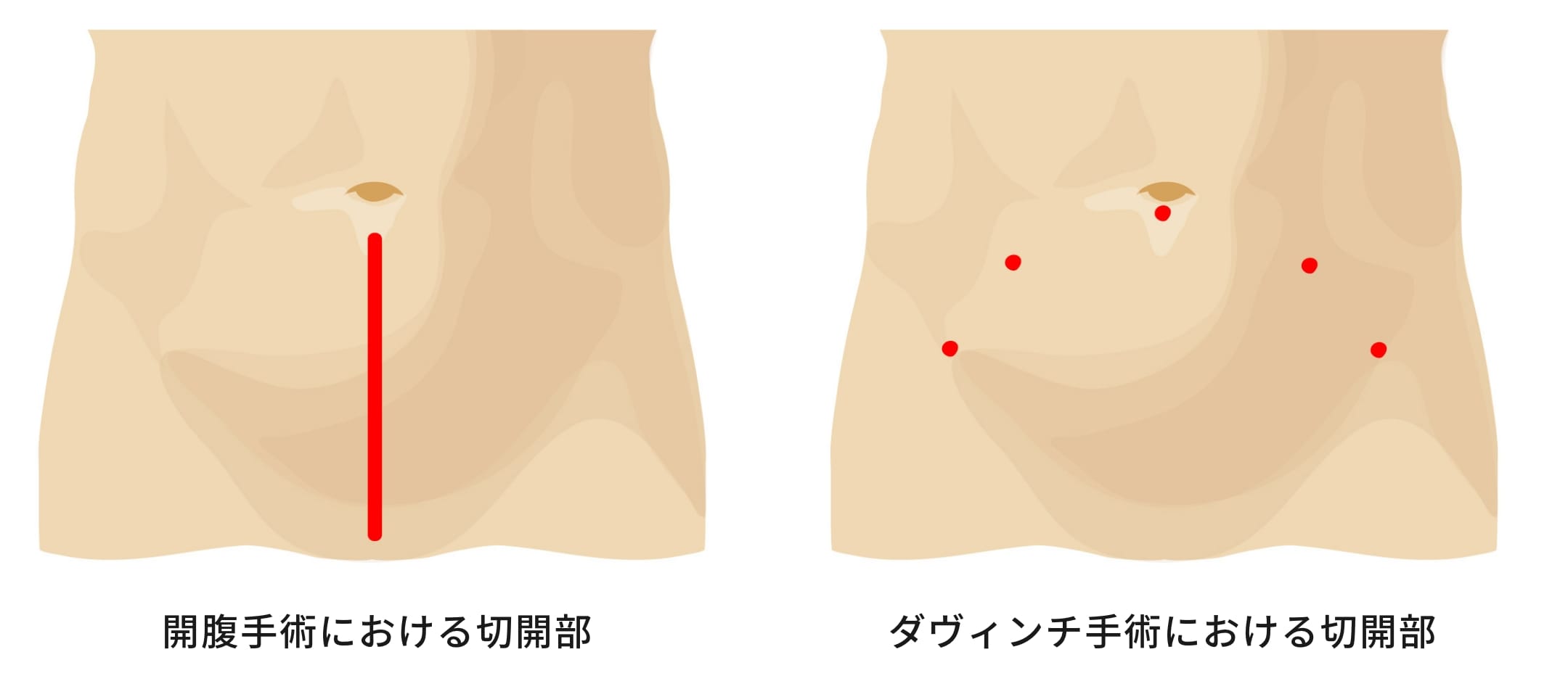 切開部